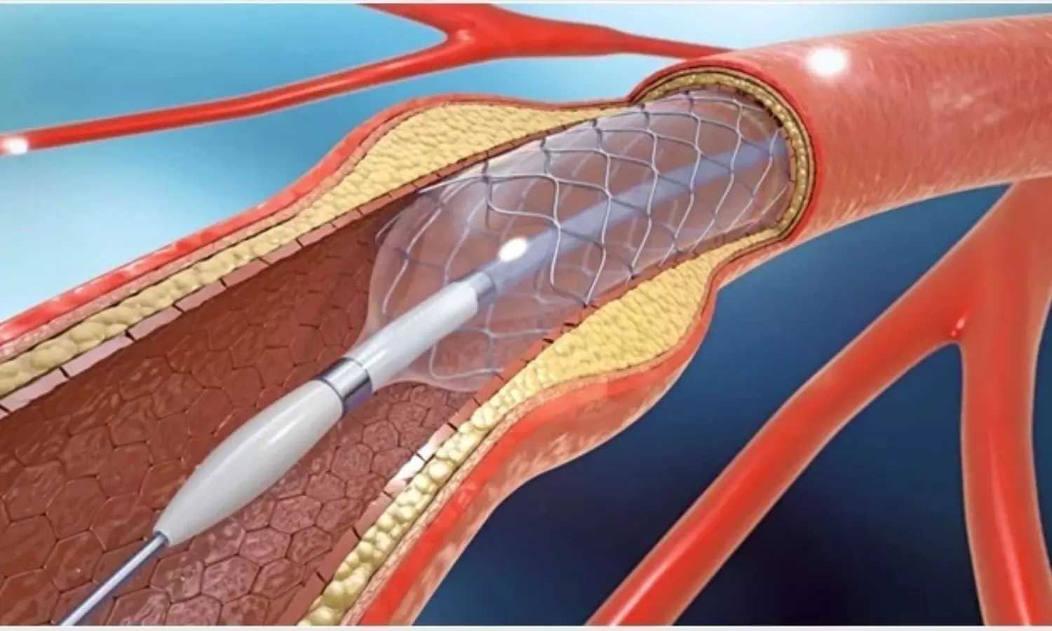 Biolimus-Eluting Stents Match Efficacy and Improve Long-Term Safety with conventional SES: