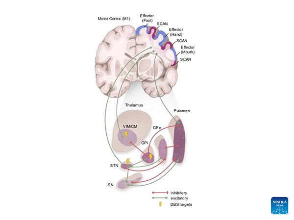 حدد علماء صينيون الشبكة الدماغية الأساسية الكامنة وراء مرض باركنسون.