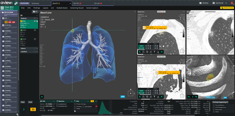 Coreline Soft Deploys Zero-Click AI Reading Workflow in U.S. Radiology Practice